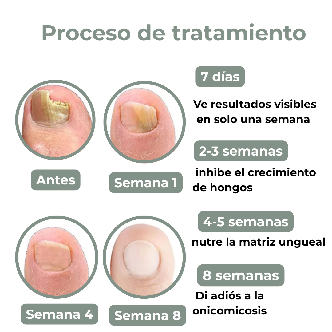 Tratamiento de los hongos de las uñas - Fungiclear™