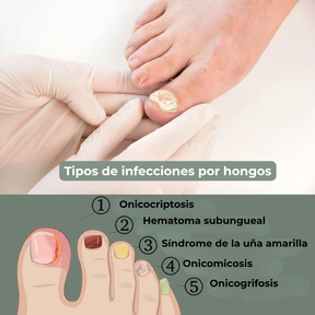 Tratamiento de los hongos de las uñas - Fungiclear™
